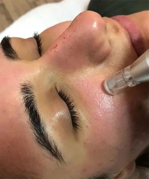 Microneedling Exosomes