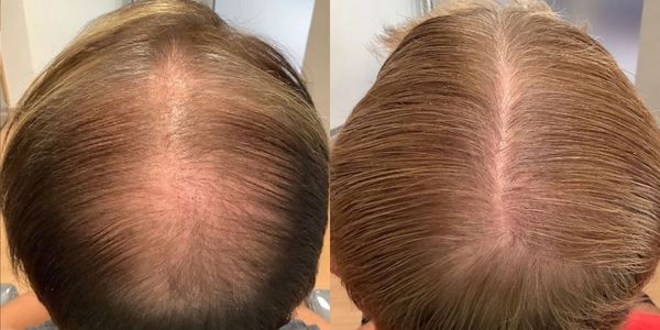 Hair regrowth treatment.