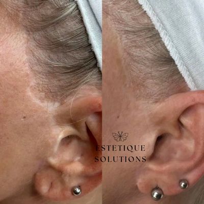Scar Revision Treatment.