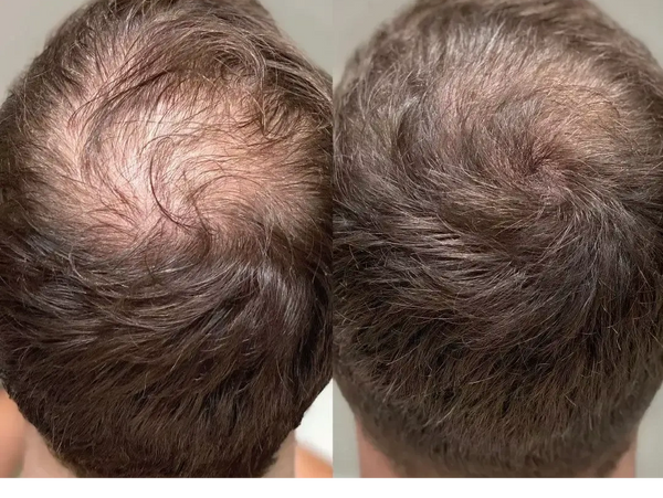 Hair loss treatment.