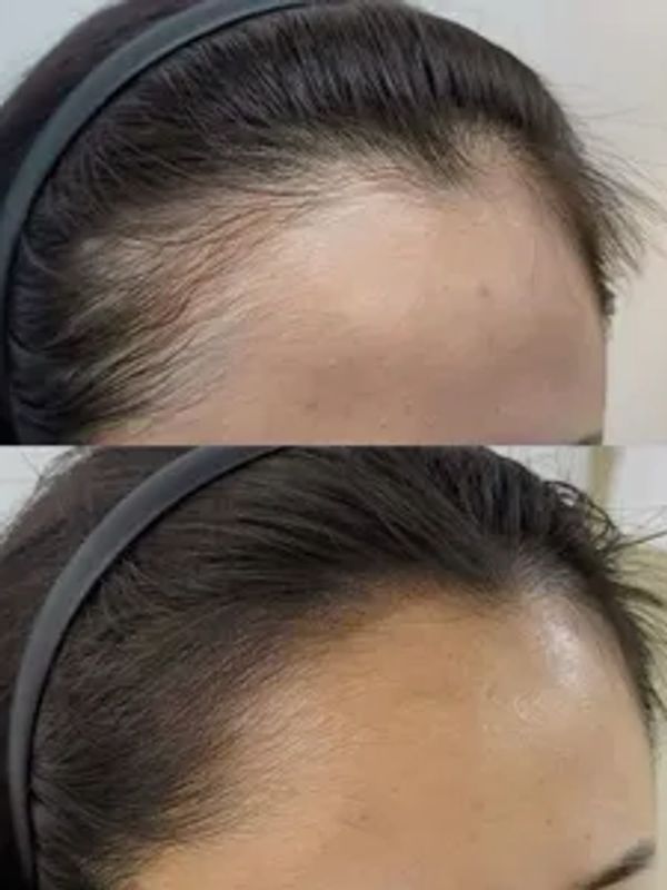 Hair regrowth treatment.