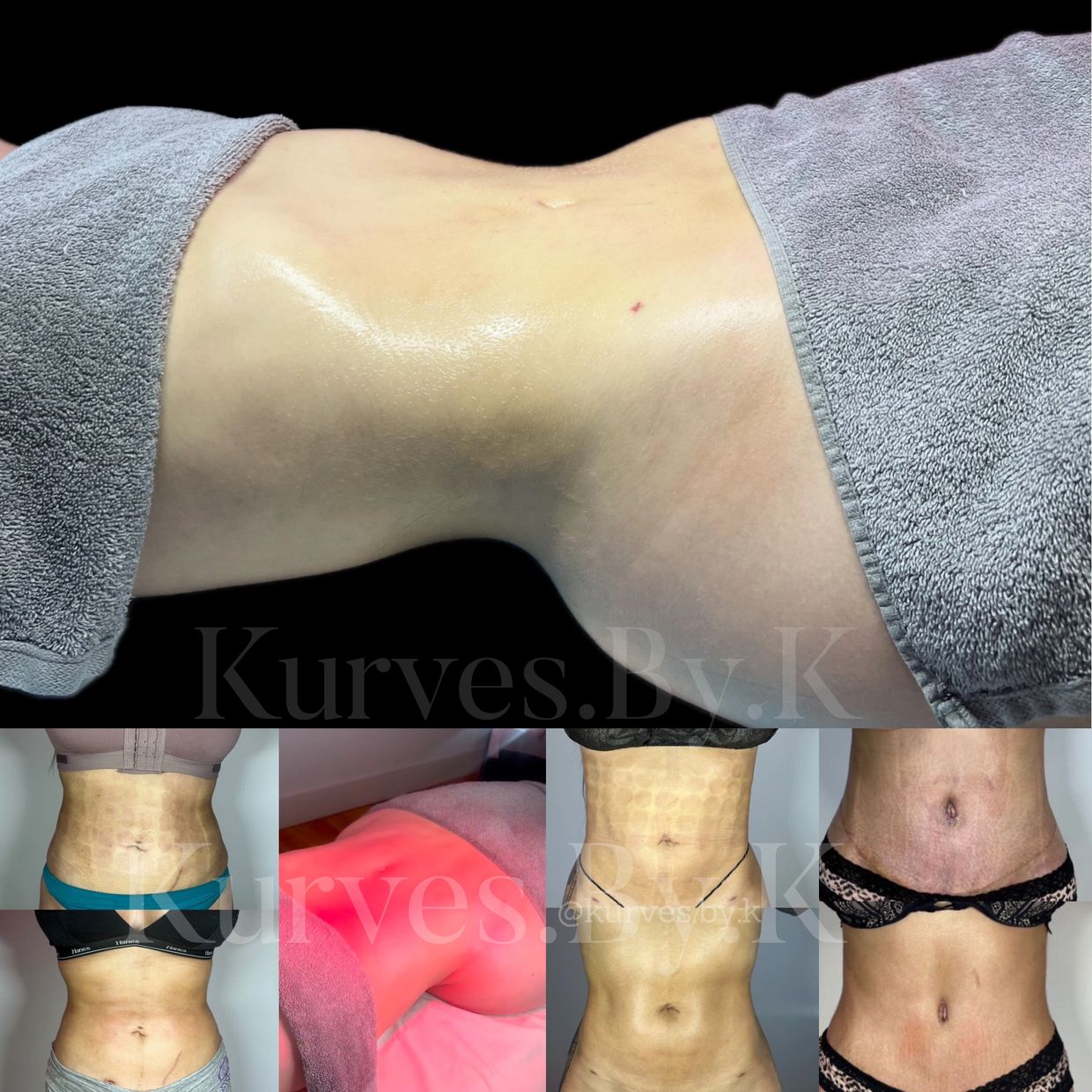 Before and after photos of post-op massage recovery treatment showing toned abdomens.