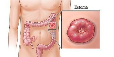 ostomias -www.coloproctologopuebla.com