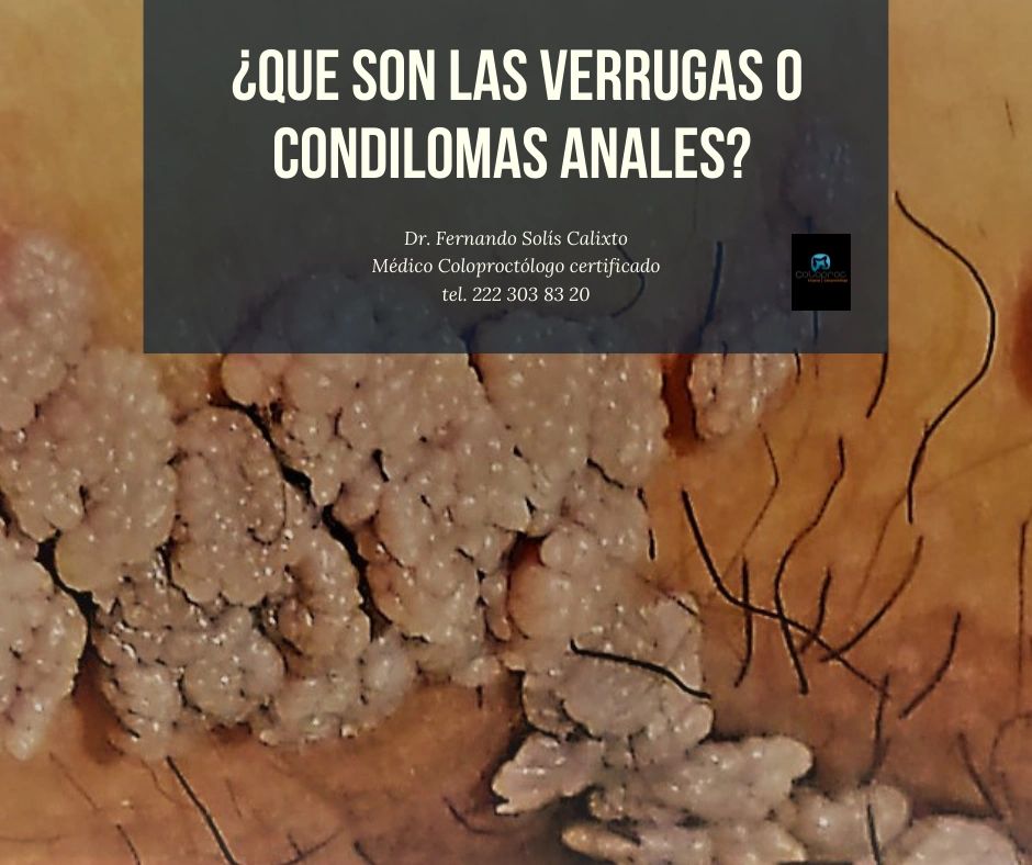 ¿Qué son las verrugas o condilomas
