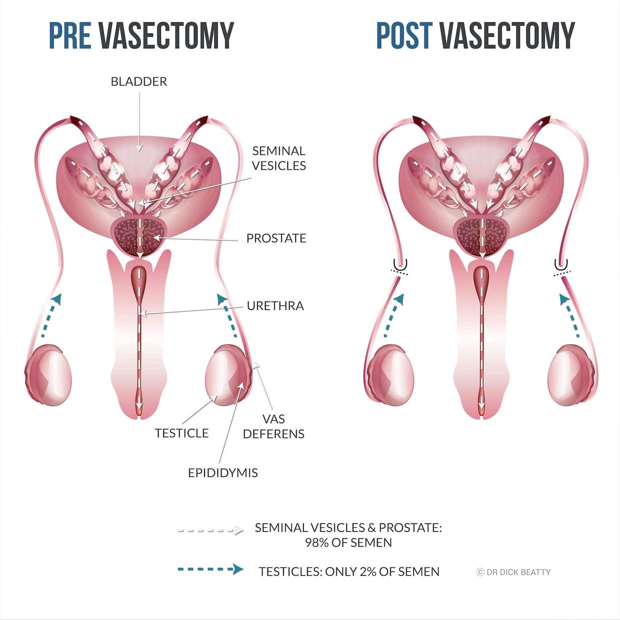 11 Top-tips Pre and Post-Vasectomy for the Best Results 