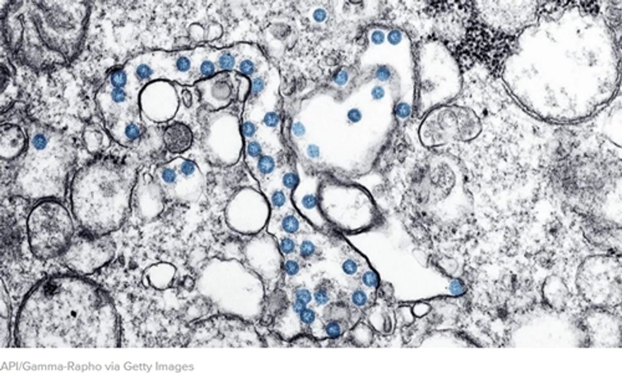 Image of blood containing the SARS-CoV-2 virus, magnified and examined under the electron microscope