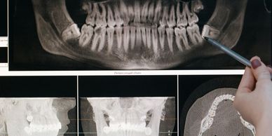 Wisdom Teeth