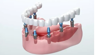 Dental Implants