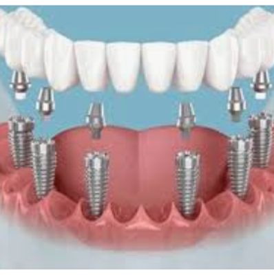 Basal Implantology in cases of poor or receding gums due to excessive bone loss.