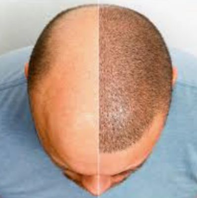 Before and After indicating the change after hair transplant.