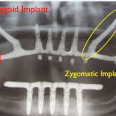 Zygomatic treatment for extreme bone loss at the Upper jaw of the patient.