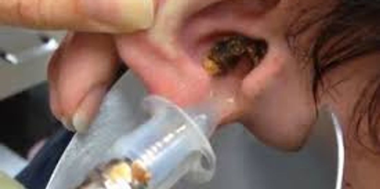 Ear Syringing  Bespoke Hearing Ear Wax Removal