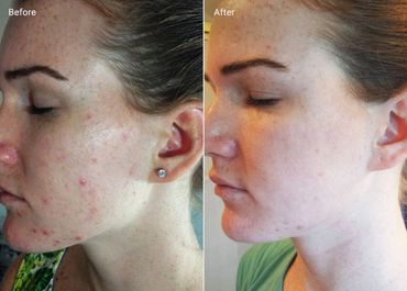 After 6 Microdermabrasion treatments and red light therapy. 
