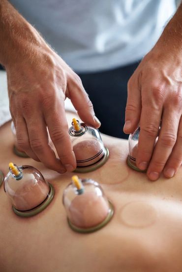 Hands applying cupping therapy cups on a person's back.