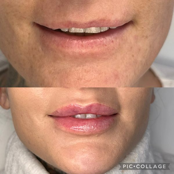 Powiększanie ust przed i po - naturalny efekt 
Easy Beauty Warszawa