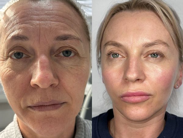 Spektakularna metamorfoza przy zachowaniu naturalnych rysów twarzy. 