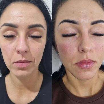 Wypełnienie bruzd nosowo - wargowych 