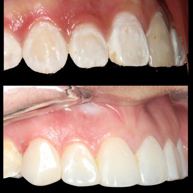 Diseño de sonrisa, resultados naturales, carillas dentales, ortodoncista bogota