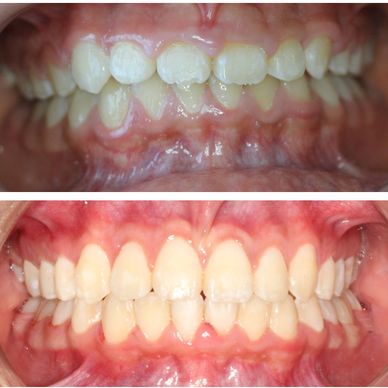 gingivectomia, diseño de sonrisa, blanqueamiento, ortodoncia bogota, ortodoncista, ortodoncia