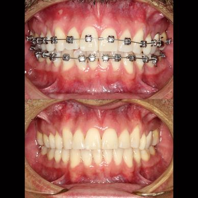 brakets autoligado, ortodoncia autoligado, ortodoncia rapida, ortodoncia comoda, ortodoncia bogota 