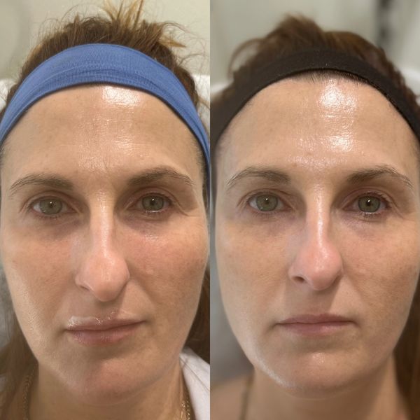 Tear trough filler 