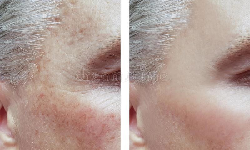 Hyperpigmentation 