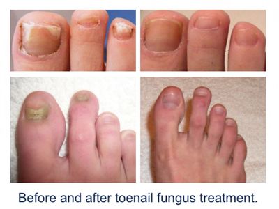 Toenail Fungus Removal Toenail Fungus Removal