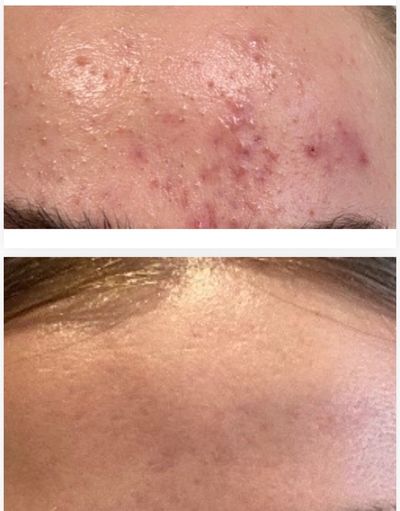 Before and after images showing significant improvement in forehead acne.