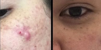 Acne laser
Laser Resurfacing 
Fraxel