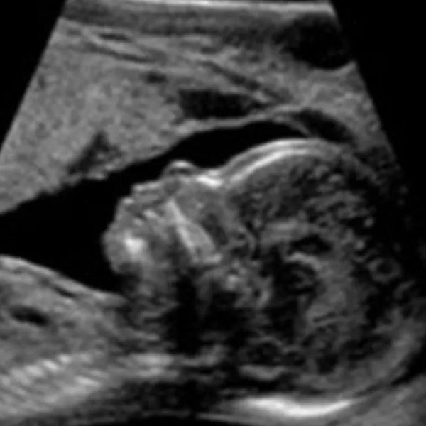Ultrasound image showing a fetal profile in the womb. Elective, Fertility, OB Images.