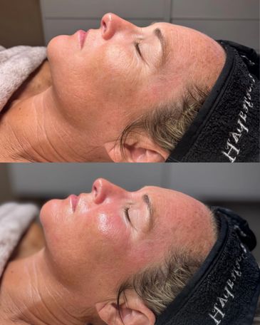 Before and after Hydrafacial facial treatment at GT Lash And Brows in Vero Beach, Florida.