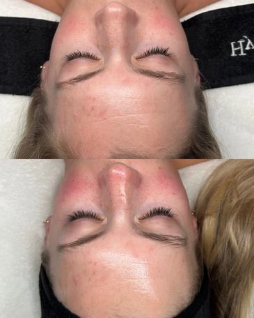 Hydrafacial skincare treatment results for smoother, younger looking skin in Vero Beach, Florida. 