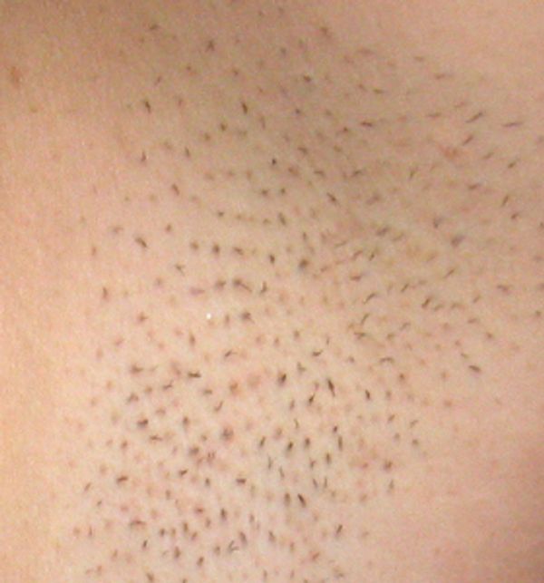 Laser Hair Removal before