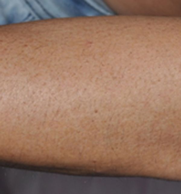 Laser Hair Removal after
