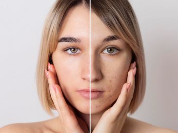 Before and after serious action acne peel application