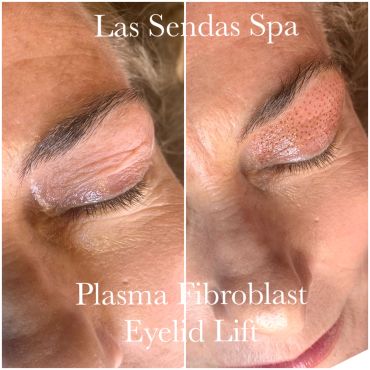 Before and after plasma fibroblast eyelid lift treatment.