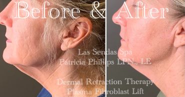 Before and after facial skin treatment showing smoother skin.