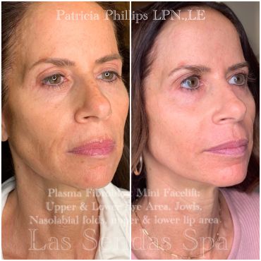 Before and after plasma fibroblast mini facelift results.