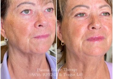 Before and after facial skin treatment for rejuvenation.