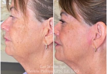 Before and after facial skin treatment on an older woman.