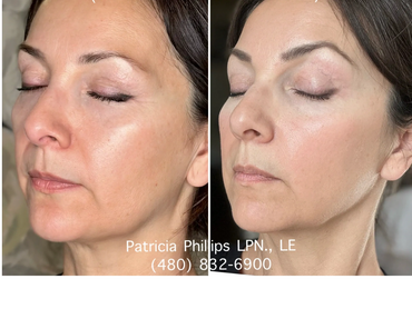 One week post Tixel treatment