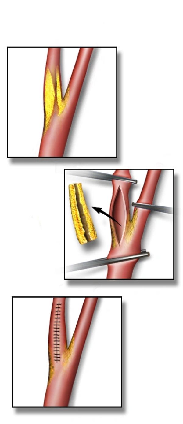 CAROTID ENDARTERECTOMY