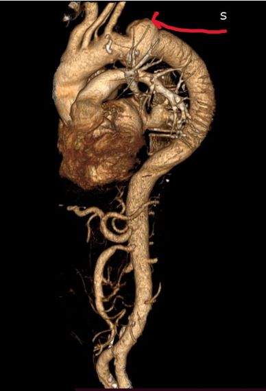 AORTIC ANEURYSM