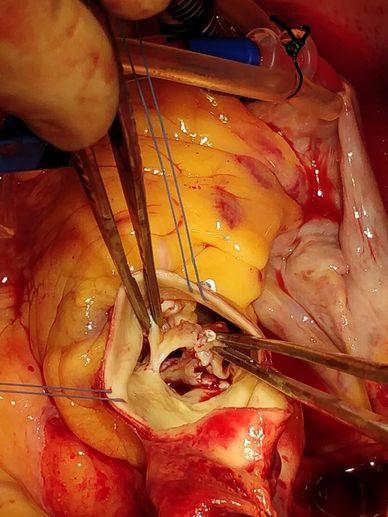 AORTIC STENOSIS