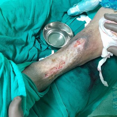 VENOUS ULCERS