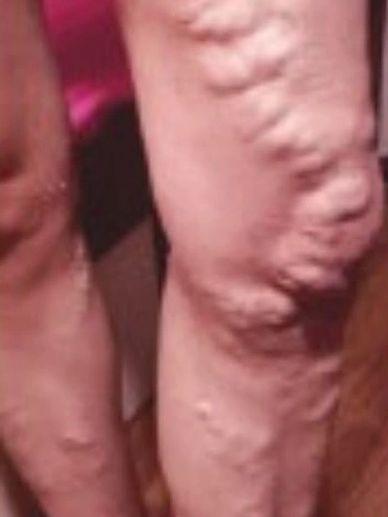 VARICOSE VEINS