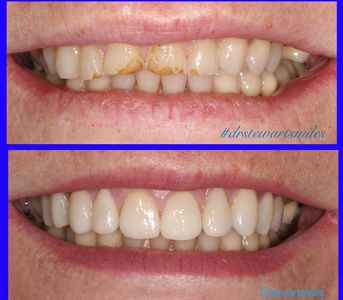 Porcelain veneers, tooth wear