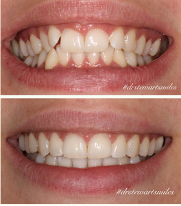 Invisalign, cosmetic dentistry