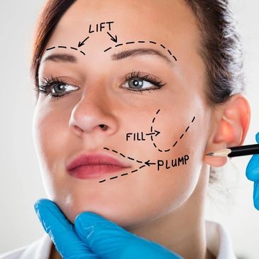 Facelift Surgery