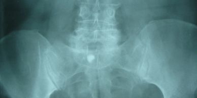 ureteric stone x ray